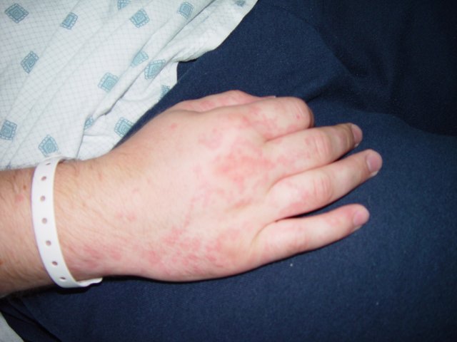 Chris' Mystery Allergic Reaction Rash